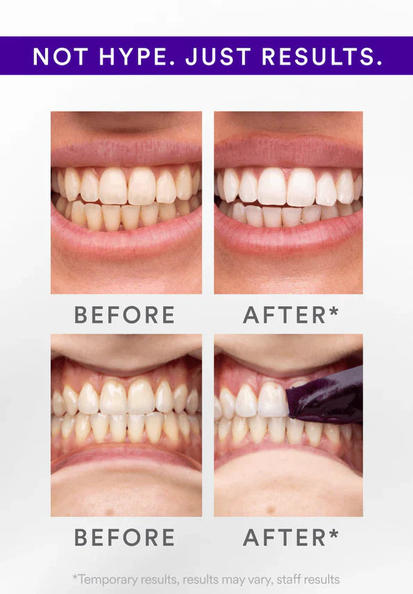 Last 3 Hours: 70% OFF๐ฅ -V34 Whitening Strips
