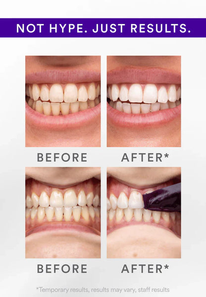 Last 3 Hours: 70% OFF🔥 -V34 Whitening Strips