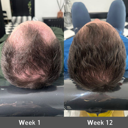 🌿👨‍⚕️ Official AU Store 🇦🇺 | 🔥Rolimey® Highly Effective Biotin & Rosemary Hair Growth Serum — (🔥 Limited-Time Offer, ⏳ Last Day Promotion 50% OFF)