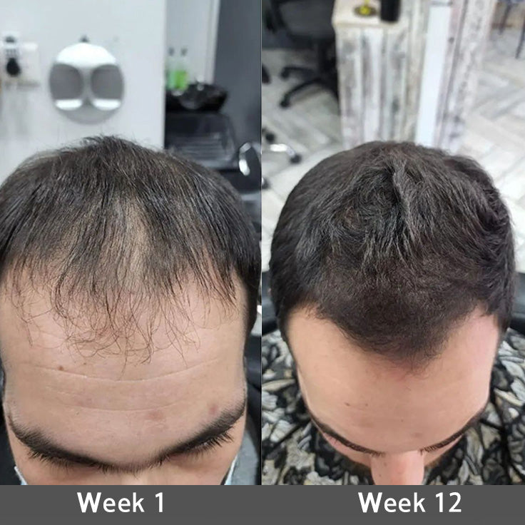 🌿👨‍⚕️ Official AU Store 🇦🇺 | 🔥Rolimey® Highly Effective Biotin & Rosemary Hair Growth Serum — (🔥 Limited-Time Offer, ⏳ Last Day Promotion 50% OFF)