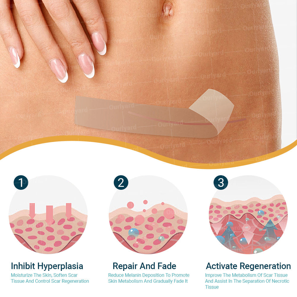 ✅Official Store |Ourlyard® Hyaluronic Acid Nano Microneedle Repair Tape🗽🎉(Treatment of old and new scars, reduction of surgical scars, stretch marks, keloids, acne, burns, warts, dermatomes and varicose veins)